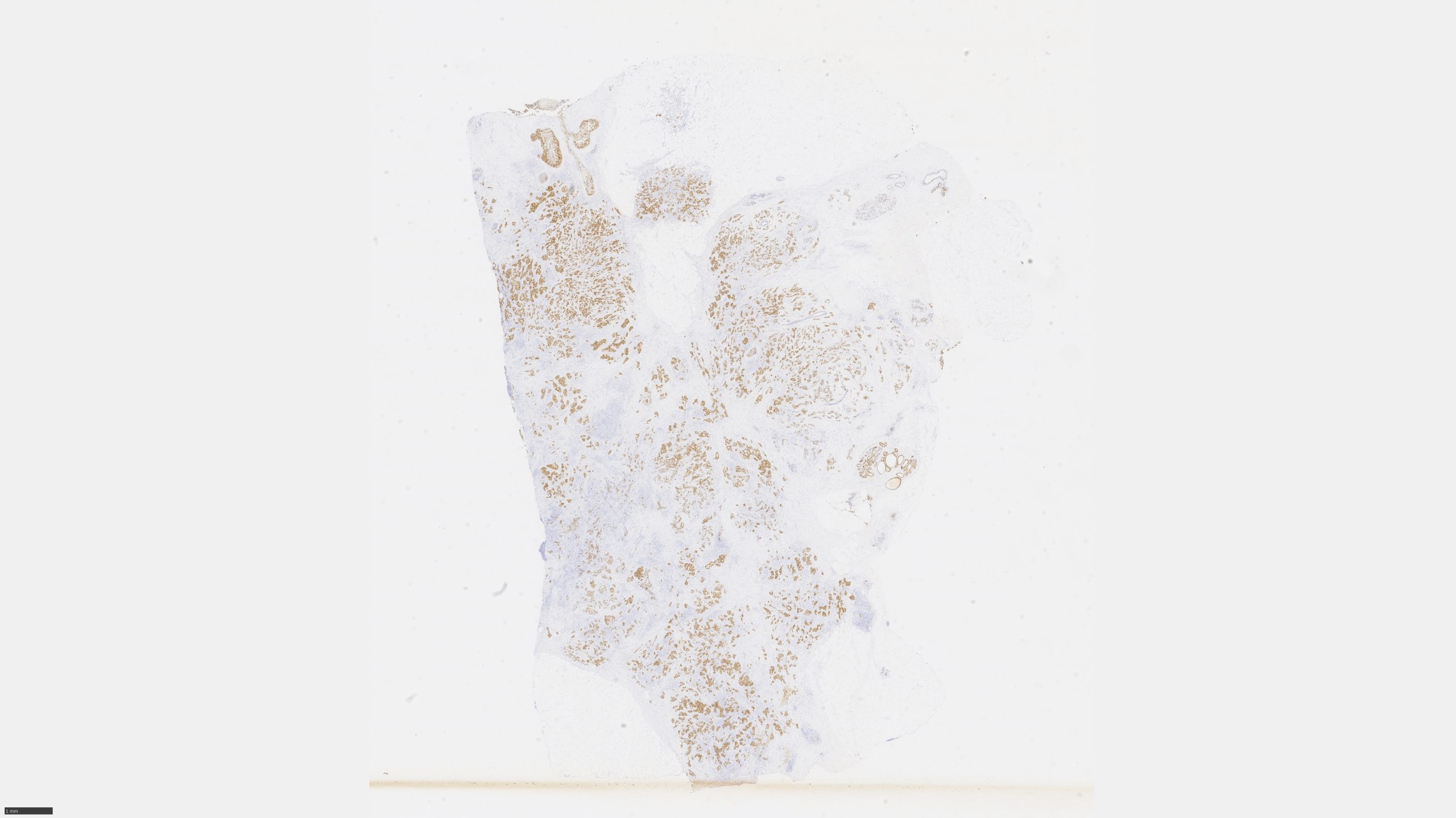 image of Breast_ER_IHC